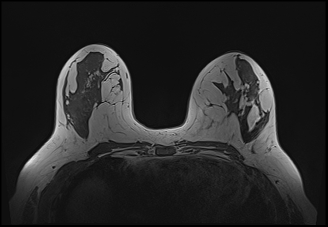 File:Normal breast MRI - dense breasts (Radiopaedia 80454-93850 Axial T1 106).jpg