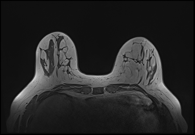 File:Normal breast MRI - dense breasts (Radiopaedia 80454-93850 Axial T1 70).jpg