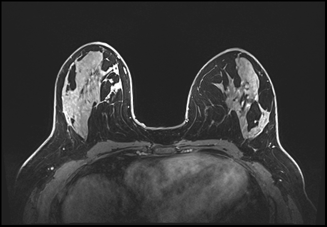 Normal breast MRI - dense breasts (Radiopaedia 80454-93850 C 104).jpg