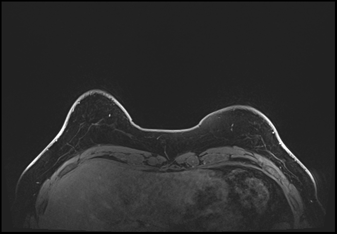 Normal breast MRI - dense breasts (Radiopaedia 80454-93850 C 29).jpg