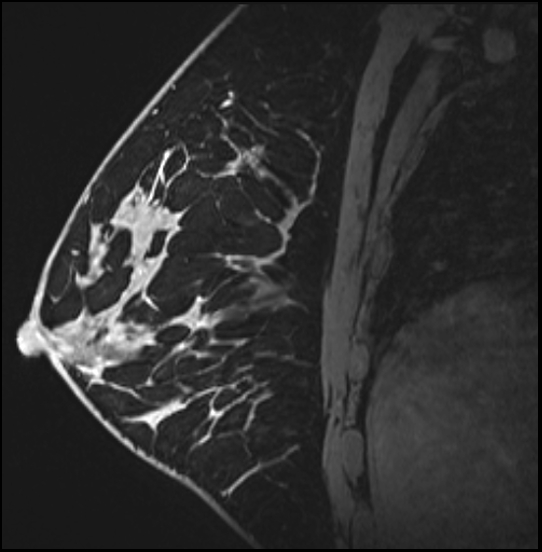Normal breast MRI - dense breasts (Radiopaedia 80454-93850 I 115).jpg