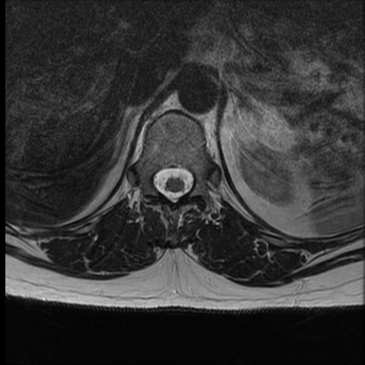 File:Normal cervical and thoracic spine MRI (Radiopaedia 35630-37156 H 9).png