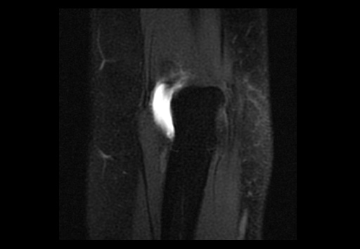 File:Normal elbow arthrograms (Radiopaedia 75550-86805 Coronal T1 fat sat 3).jpg