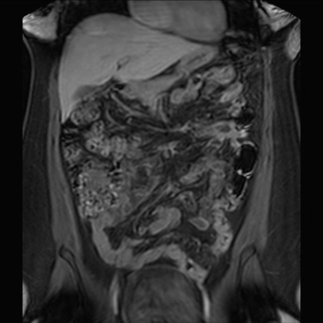 Normal liver MRI with Gadolinium (Radiopaedia 58913-66163 P 33).jpg