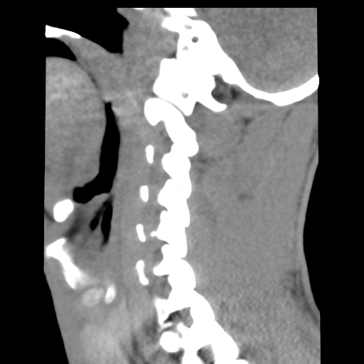 File:Normal trauma cervical spine (Radiopaedia 41017-43760 B 9).png
