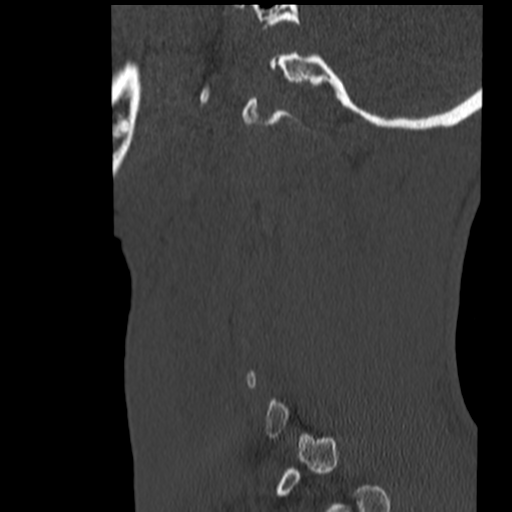 File:Normal trauma cervical spine (Radiopaedia 41017-43760 Sagittal bone window 42).png