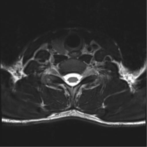 Normal trauma cervical spine (Radiopaedia 41017-43762 D 46).png