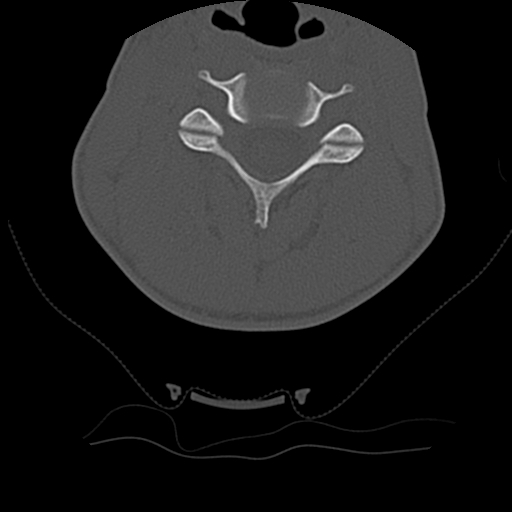 File:Normal trauma spine imaging (age 16) (Radiopaedia 45335-49358 Axial bone window 34).jpg