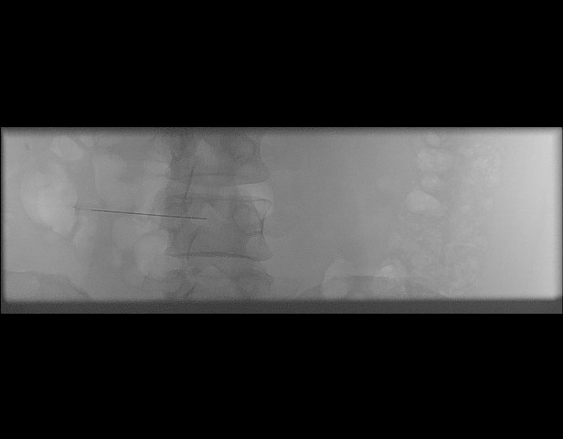 File:Oblique sublaminar lumbar puncture (Radiopaedia 90103-107280 A 41).jpeg