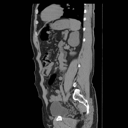File:Obstructed kidney with perinephric urinoma (Radiopaedia 26889-27066 B 46).jpg
