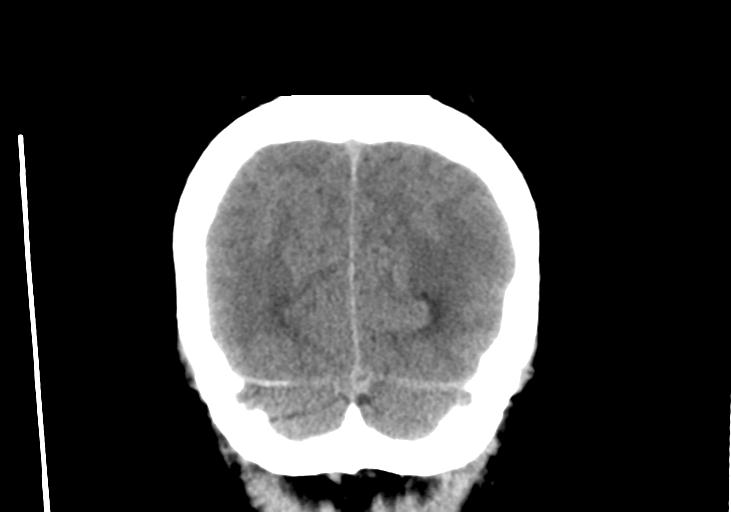 File:Obstructive hydrocephalus (Radiopaedia 30453-31119 Coronal non-contrast 34).jpg