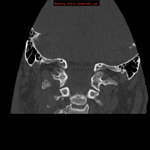 File:Occipital condyle fracture (Radiopaedia 18366-18208 Coronal bone window 14).jpg