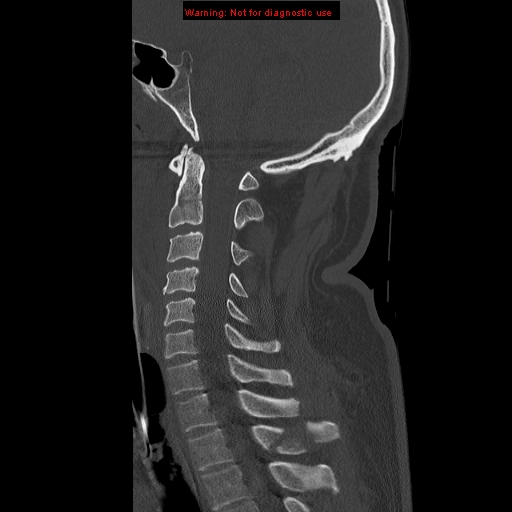 File:Occipital condyle fracture (Radiopaedia 18366-18208 Sagittal bone window 18).jpg