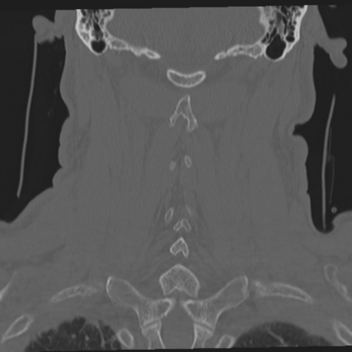 File:Occipital condyle fracture (Radiopaedia 33467-34517 Coronal bone window 49).png