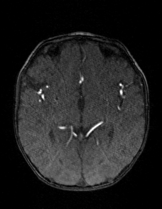 Occipital horn syndrome (Radiopaedia 14255-14129 MRA 77).jpg
