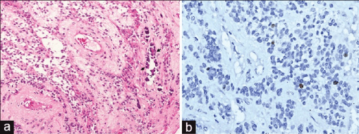 a)Microphotographs of supratentorial ependymomas shows Grade II ependymoma b) tumor shows low MIB-1 labeling.