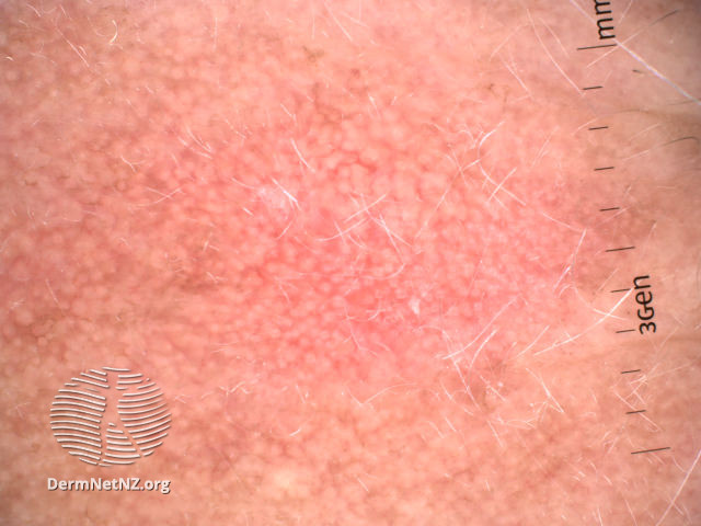 File:Strawberry pattern dermoscopy of facial actinic keratosis (DermNet NZ strawberry-pattern-ak-3).jpg