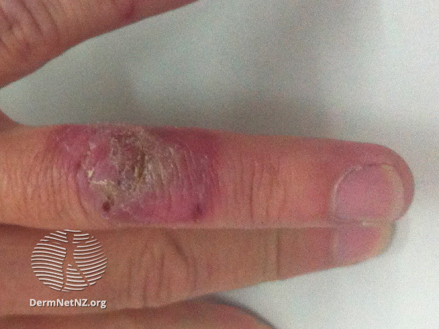 File:4 weeks after diagnosis (DermNet NZ anthrax-03).jpg