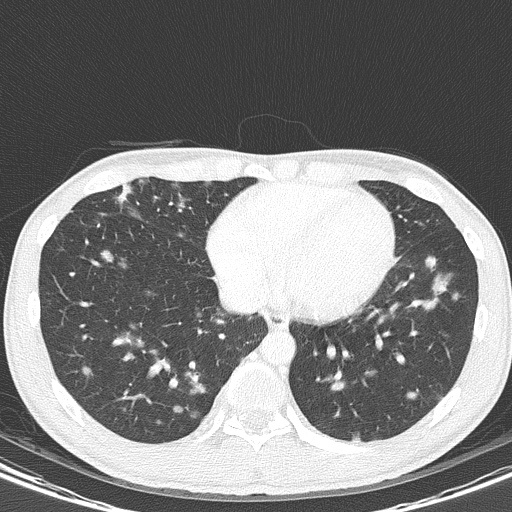 AIDS-related Kaposi sarcoma (Radiopaedia 85247-100811 Axial lung window 125).jpg