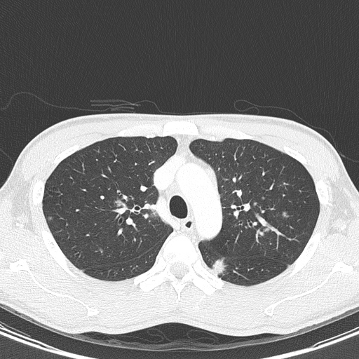 AIDS-related Kaposi sarcoma (Radiopaedia 85247-100811 Axial lung window 48).jpg