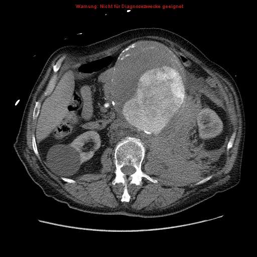 Abdominal aortic aneurysm- extremely large, ruptured (Radiopaedia 19882-19921 Axial C+ arterial phase 29).jpg