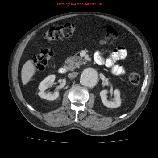 Abdominal aortic aneurysm (Radiopaedia 10122-10660 Axial C+ portal venous phase 30).jpg