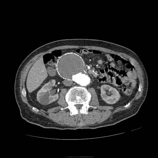 Abdominal aortic aneurysm (Radiopaedia 13341-13340 Axial C+ arterial phase 91).jpg