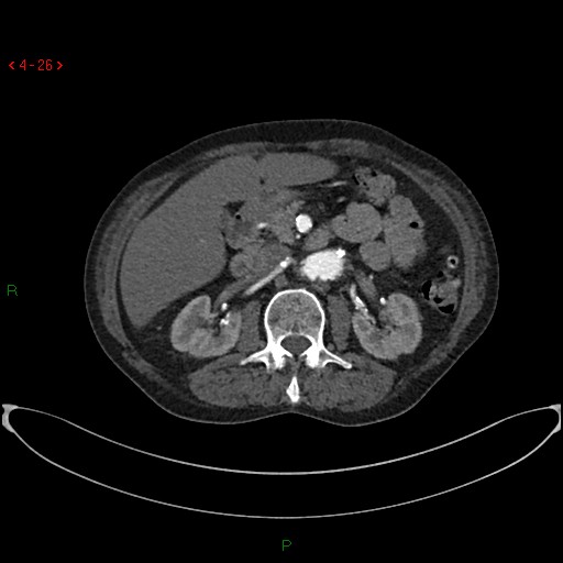 File:Abdominal aortic aneurysm (Radiopaedia 16155-15834 Axial C+ arterial phase 6).jpg