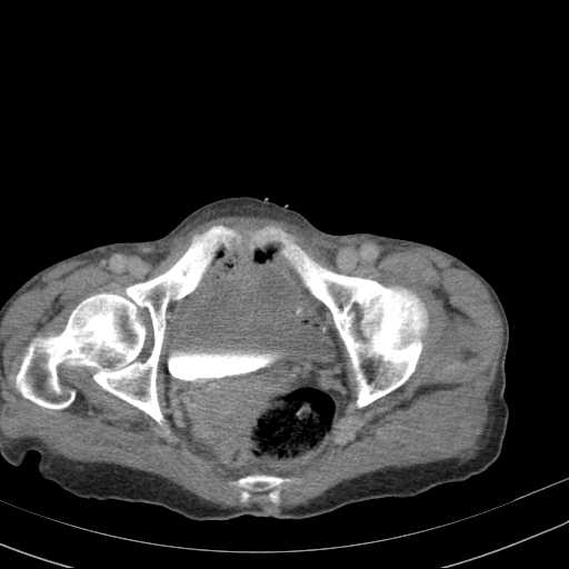 File:Abdominal aortic aneurysm (Radiopaedia 20827-20742 Axial C+ delayed 35).jpg