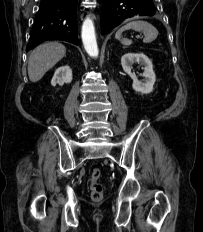 Abdominal aortic aneurysm (Radiopaedia 25855-26001 Coronal C+ arterial phase 53).jpg