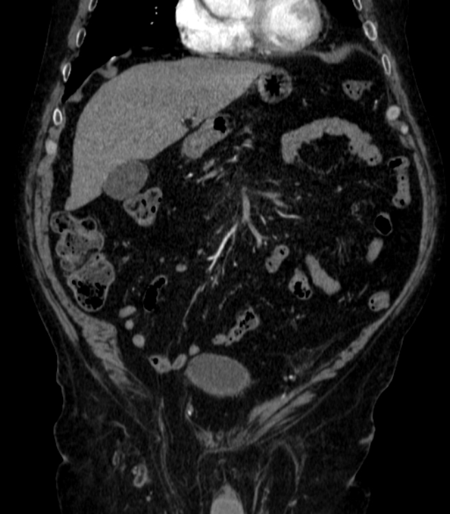 Abdominal aortic aneurysm (Radiopaedia 25855-26001 Coronal C+ arterial phase 8).jpg