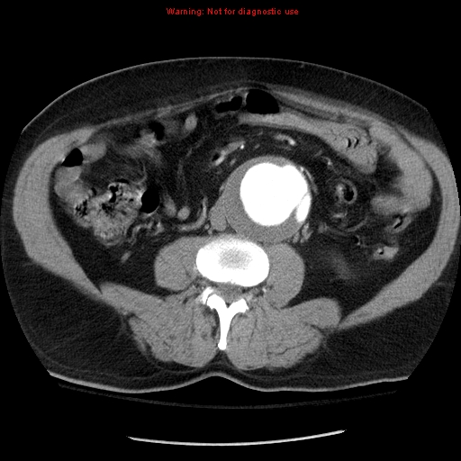 Abdominal aortic aneurysm (Radiopaedia 8190-9038 Axial C+ arterial phase 45).jpg