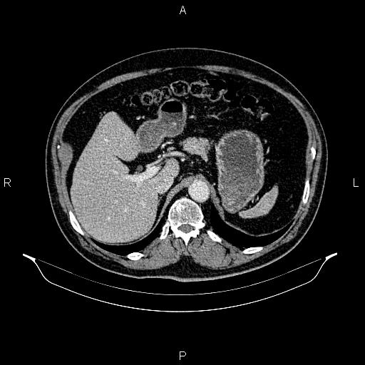 Abdominal aortic aneurysm (Radiopaedia 83094-97462 Axial renal cortical phase 78).jpg