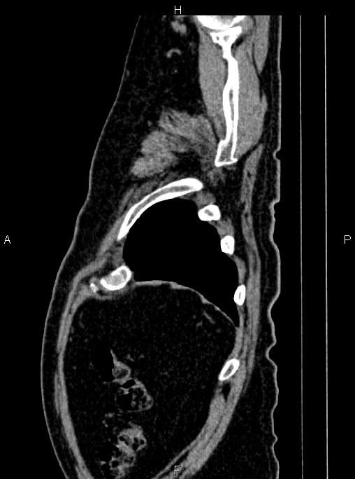Abdominal aortic aneurysm (Radiopaedia 83094-97462 Sagittal renal cortical phase 113).jpg