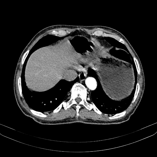 Abdominal aortic aneurysm (Radiopaedia 83581-98689 Axial C+ arterial phase 16).jpg