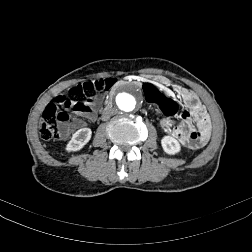 Abdominal aortic aneurysm (Radiopaedia 83581-98689 Axial C+ arterial phase 63).jpg