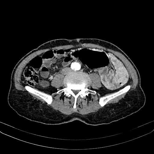 Abdominal aortic aneurysm (Radiopaedia 83581-98689 Axial C+ arterial phase 74).jpg