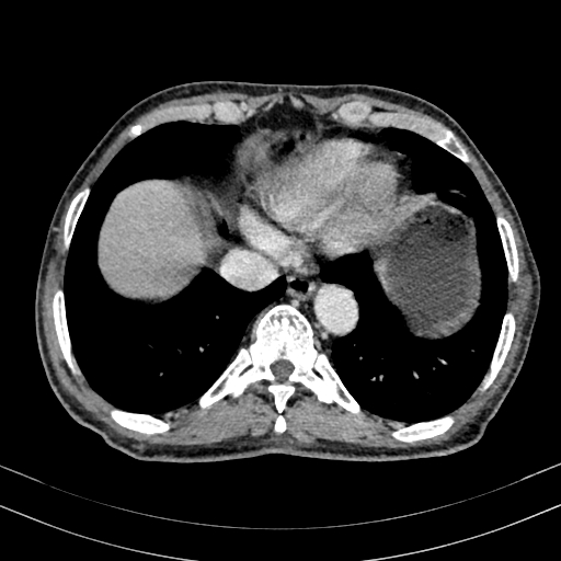 Abdominal aortic aneurysm (Radiopaedia 83581-98689 Axial C+ portal venous phase 10).jpg