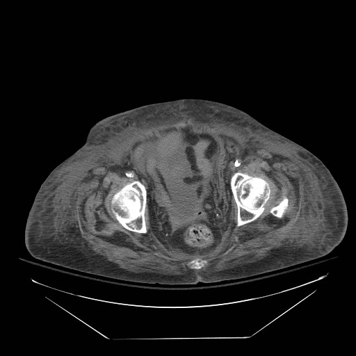 File:Abdominal aortic aneurysm - impending rupture (Radiopaedia 19233-19247 Axial non-contrast 151).jpg