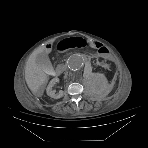 Abdominal aortic aneurysm - impending rupture (Radiopaedia 19233-19247 Axial non-contrast 79).jpg