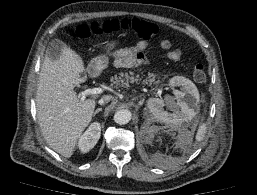 Abdominal aortic aneurysm rupture (Radiopaedia 54179-60362 Axial C+ portal venous phase 29).jpg
