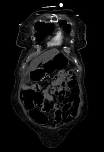 Abdominal aortic aneurysm with thrombus fissuration (Radiopaedia 73192-83919 Coronal C+ arterial phase 3).jpg