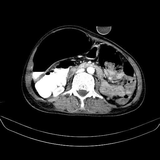 File:Abdominal collection due to previous cecal perforation (Radiopaedia 80831-94320 Axial C+ portal venous phase 100).jpg