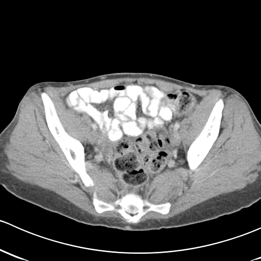 File:Abdominal desmoid tumor (Radiopaedia 41007-43740 Axial C+ portal venous phase 59).png