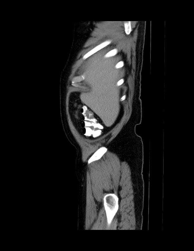 Abdominal lymphoma - with sandwich sign (Radiopaedia 53486-59492 Sagittal C+ portal venous phase 73).jpg