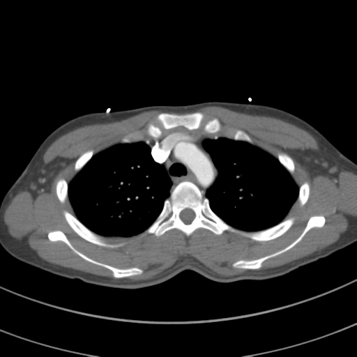 File:Abdominal multi-trauma - devascularised kidney and liver, spleen and pancreatic lacerations (Radiopaedia 34984-36486 Axial C+ arterial phase 24).png
