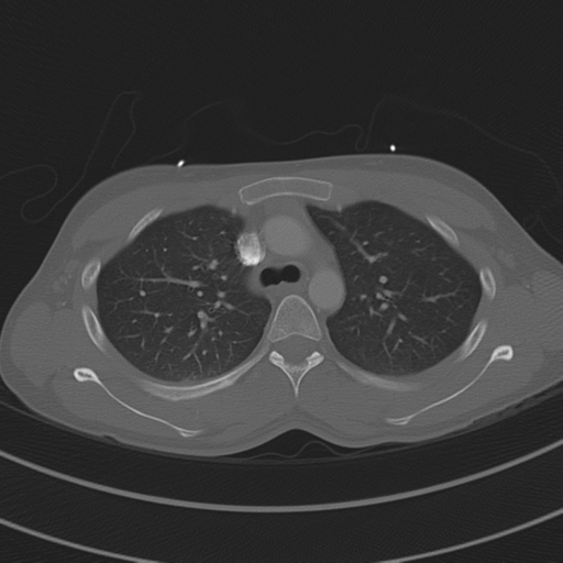 File:Abdominal multi-trauma - devascularised kidney and liver, spleen and pancreatic lacerations (Radiopaedia 34984-36486 I 28).png