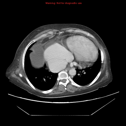 File:Abdominal wall hematoma (Radiopaedia 9427-10112 Axial C+ portal venous phase 10).jpg