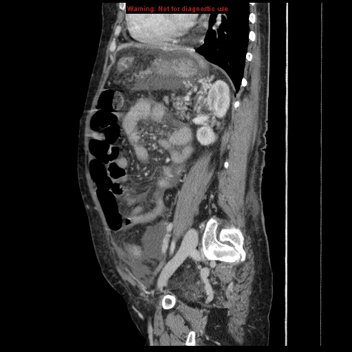 Abdominal wall hematoma (Radiopaedia 9427-10112 Sagittal C+ portal venous phase 37).jpg