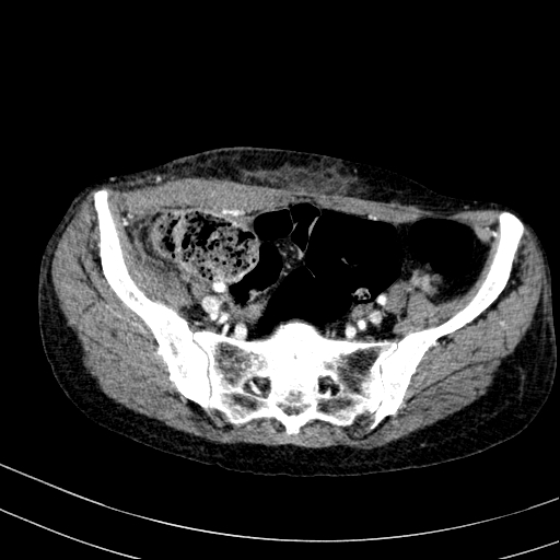 Abdominal wall hematoma with active bleeding (Radiopaedia 83915-99117 Axial renal cortical phase 104).jpg